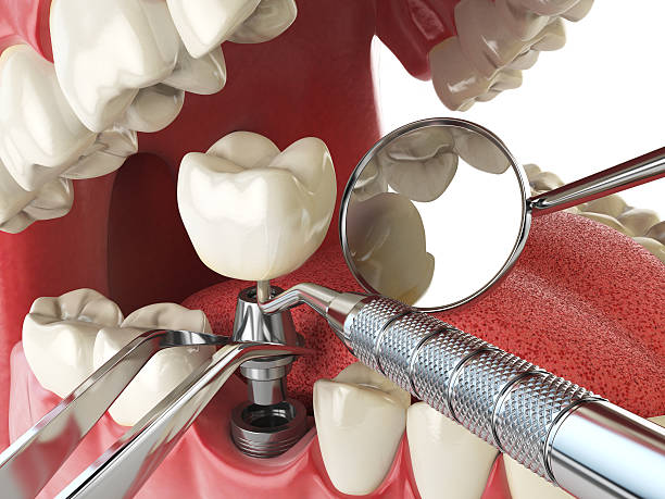 Best Emergency Dental Care for Broken or Chipped Teeth in Nashwauk, MN